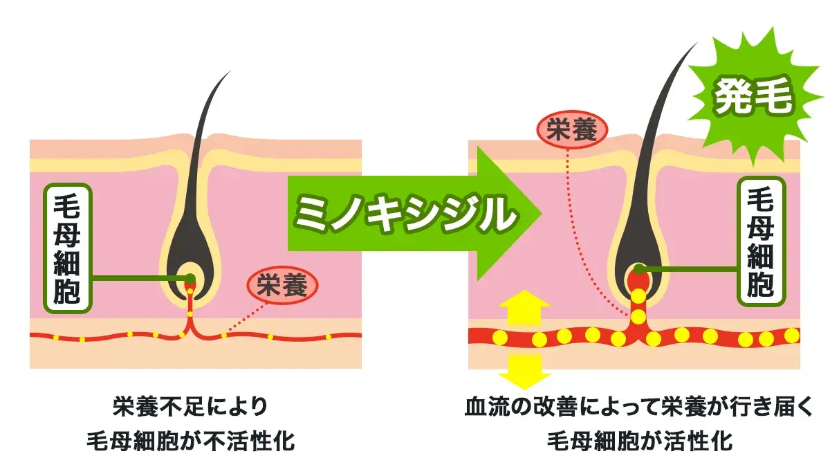 フィンペシア+ミノキシジルタブレット(3ヶ月分)のAGA改善の仕組み2