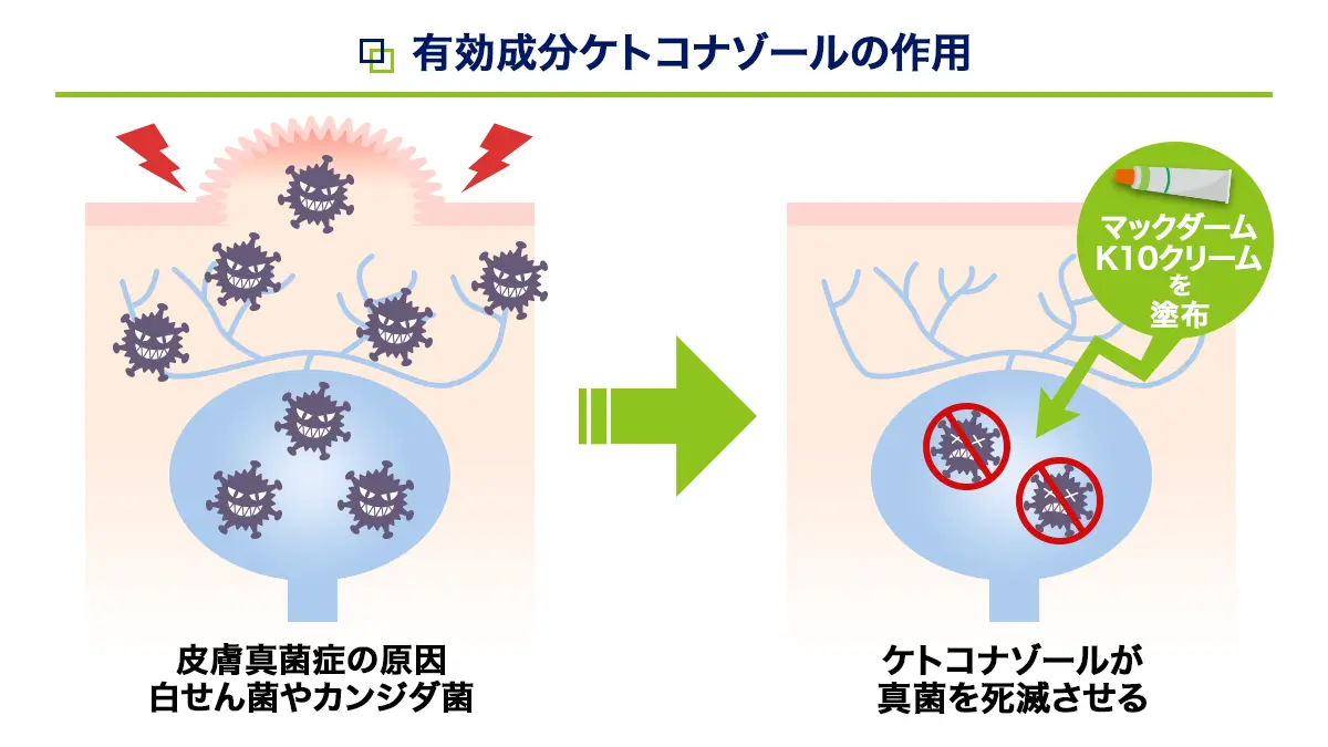有効成分ケトコナゾールの作用
