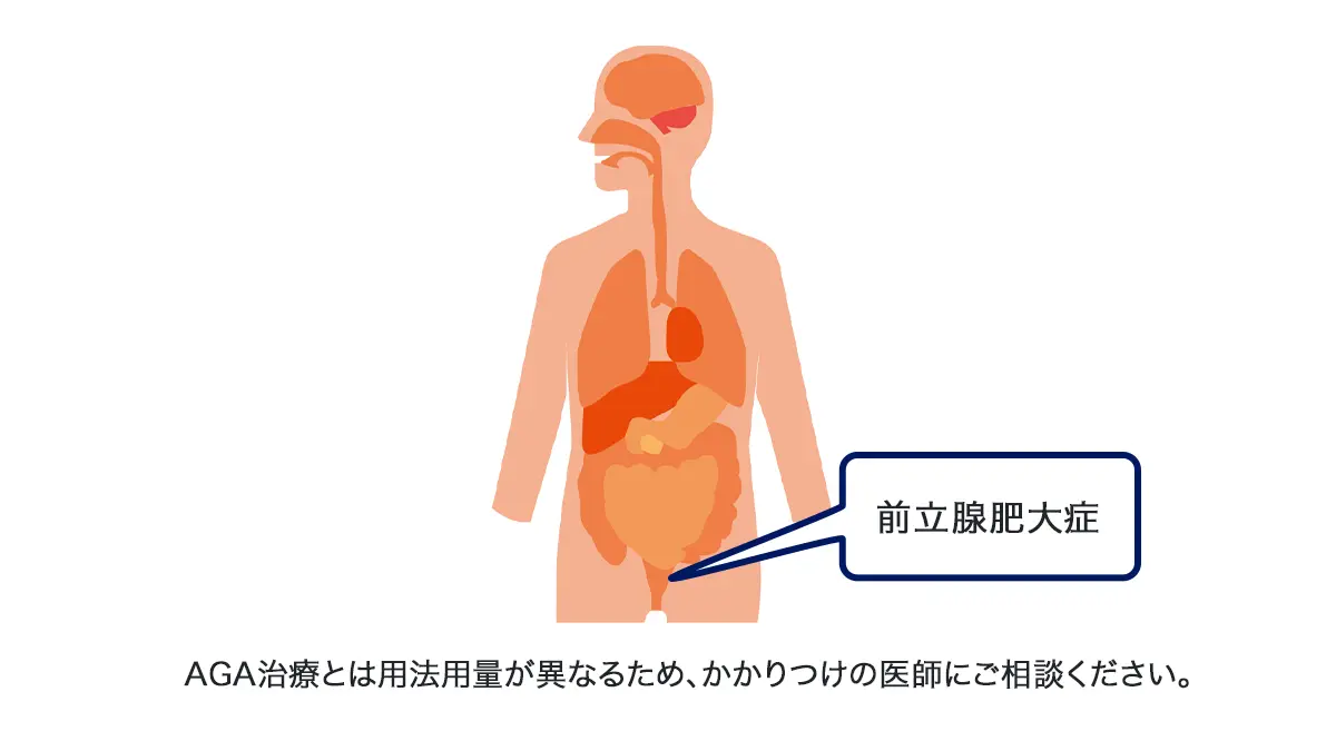 デュタストロン+ミノクソール(各180錠)の隠されたメリット