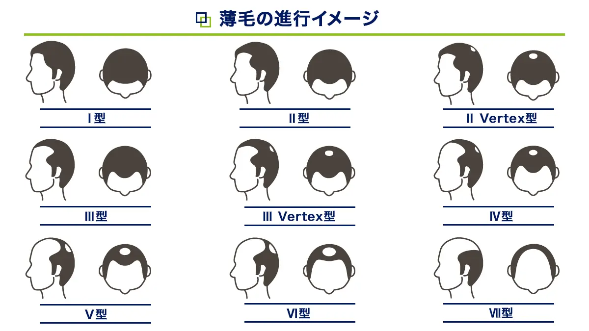 薄毛の進行イメージ