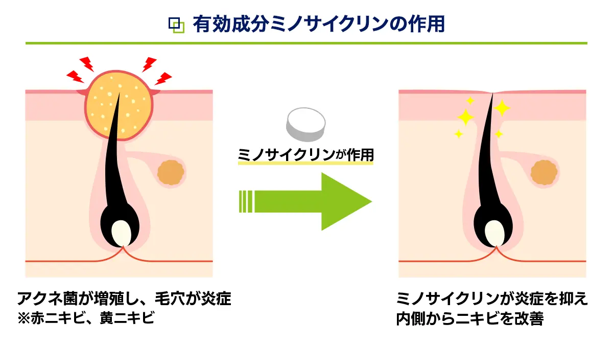有効成分ミノサイクリンの作用