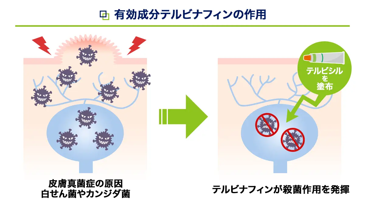 テルビシルの有効成分