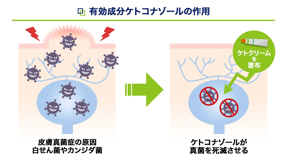 有効成分ケトコナゾールの作用