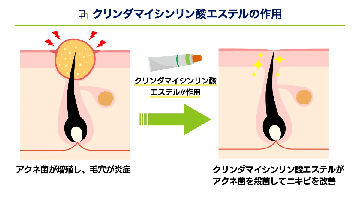 クリンダマイシンゲルの有効成分