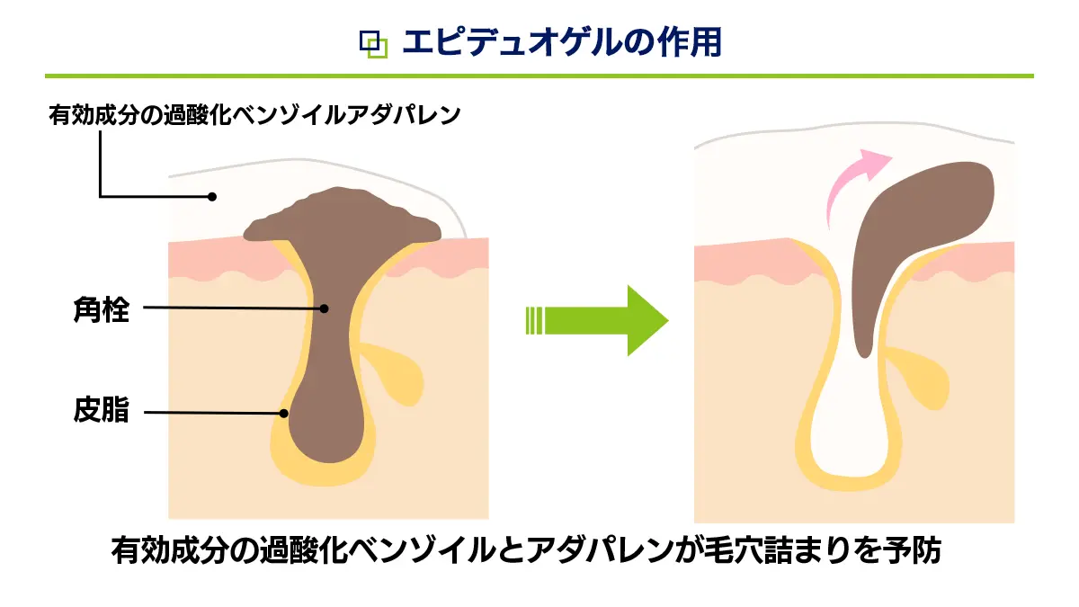 エピデュオゲルの有効成分