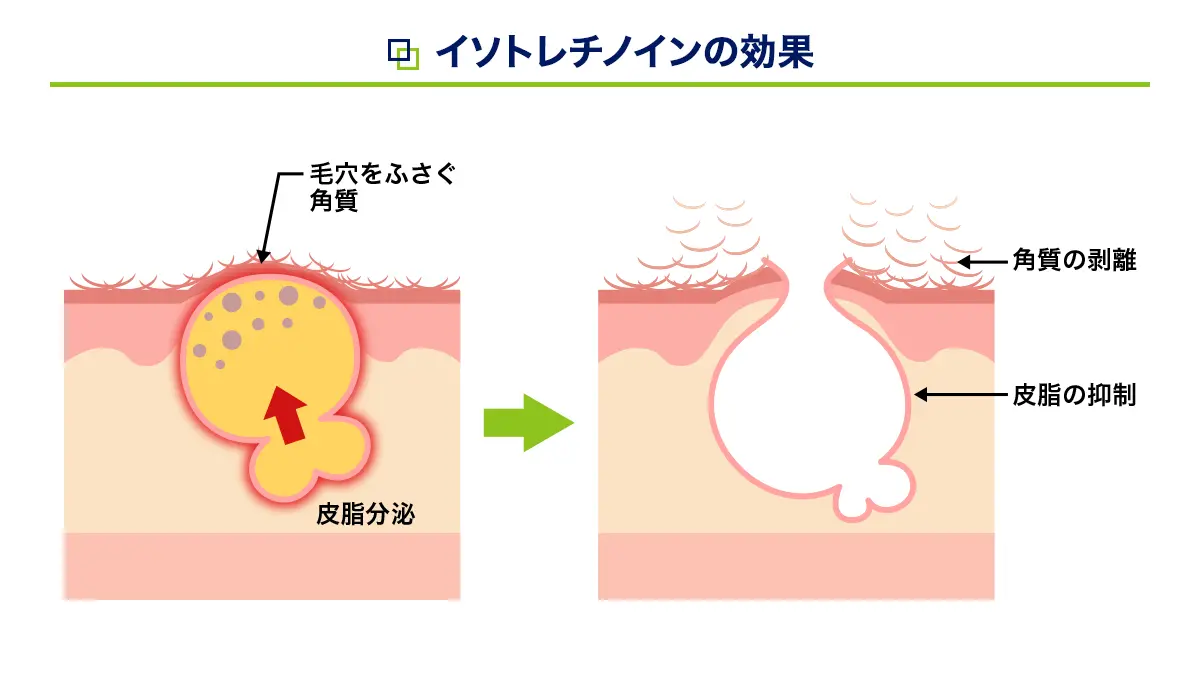 トレティヴァの効果